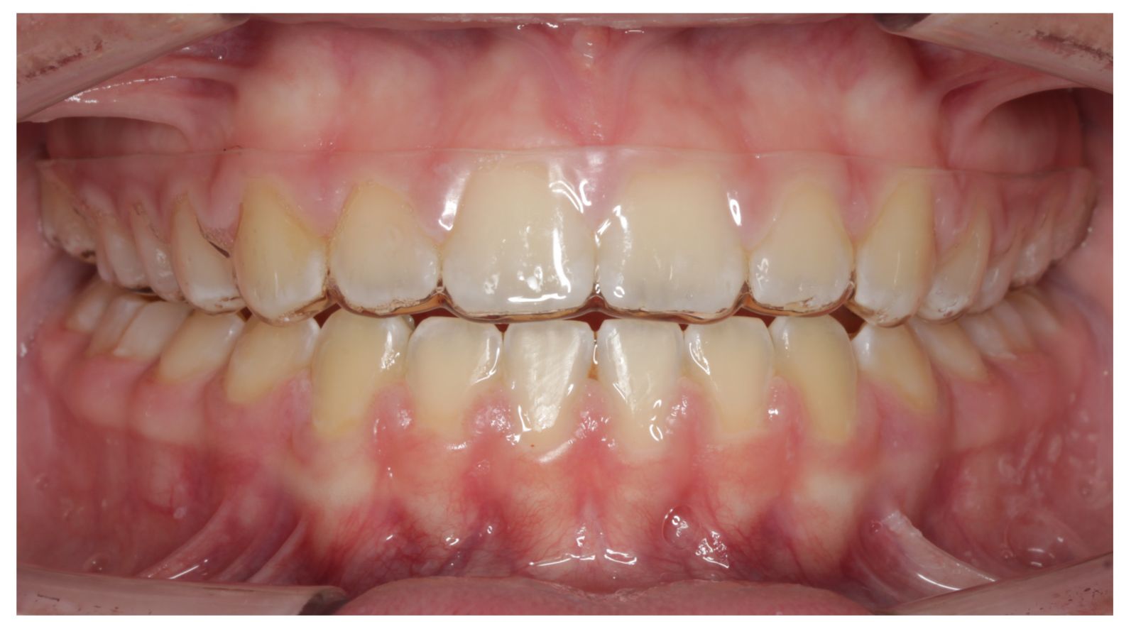 Retainer Care - Hart Orthodontics | Woodbridge VA